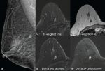 Diffusion MRI as a Stand-Alone Unenhanced Approach for Breast Imaging and Screening