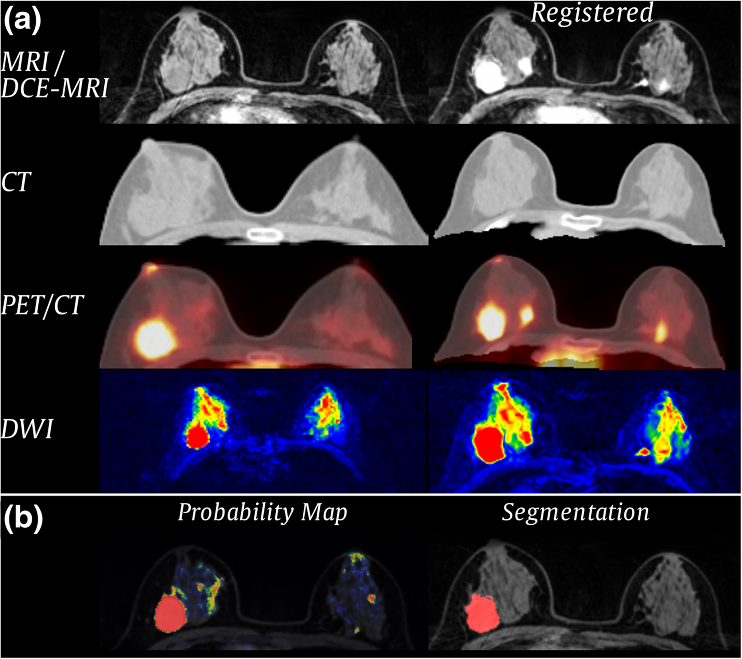 Breast imaging Radiology Key