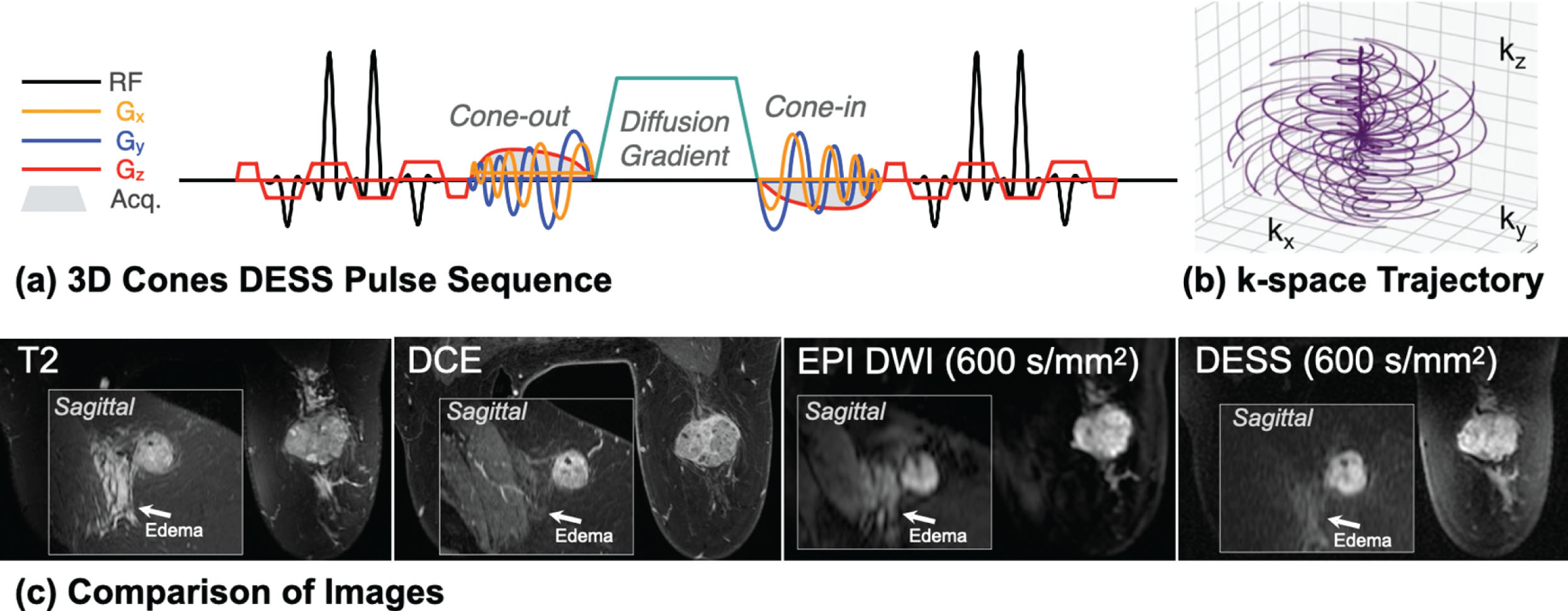 high-resolution-diffusion-weighted-breast-mri-acquisition-radiology-key