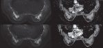 Breast Diffusion MRI Acquisition and Processing Techniques: The GE Healthcare Perspective