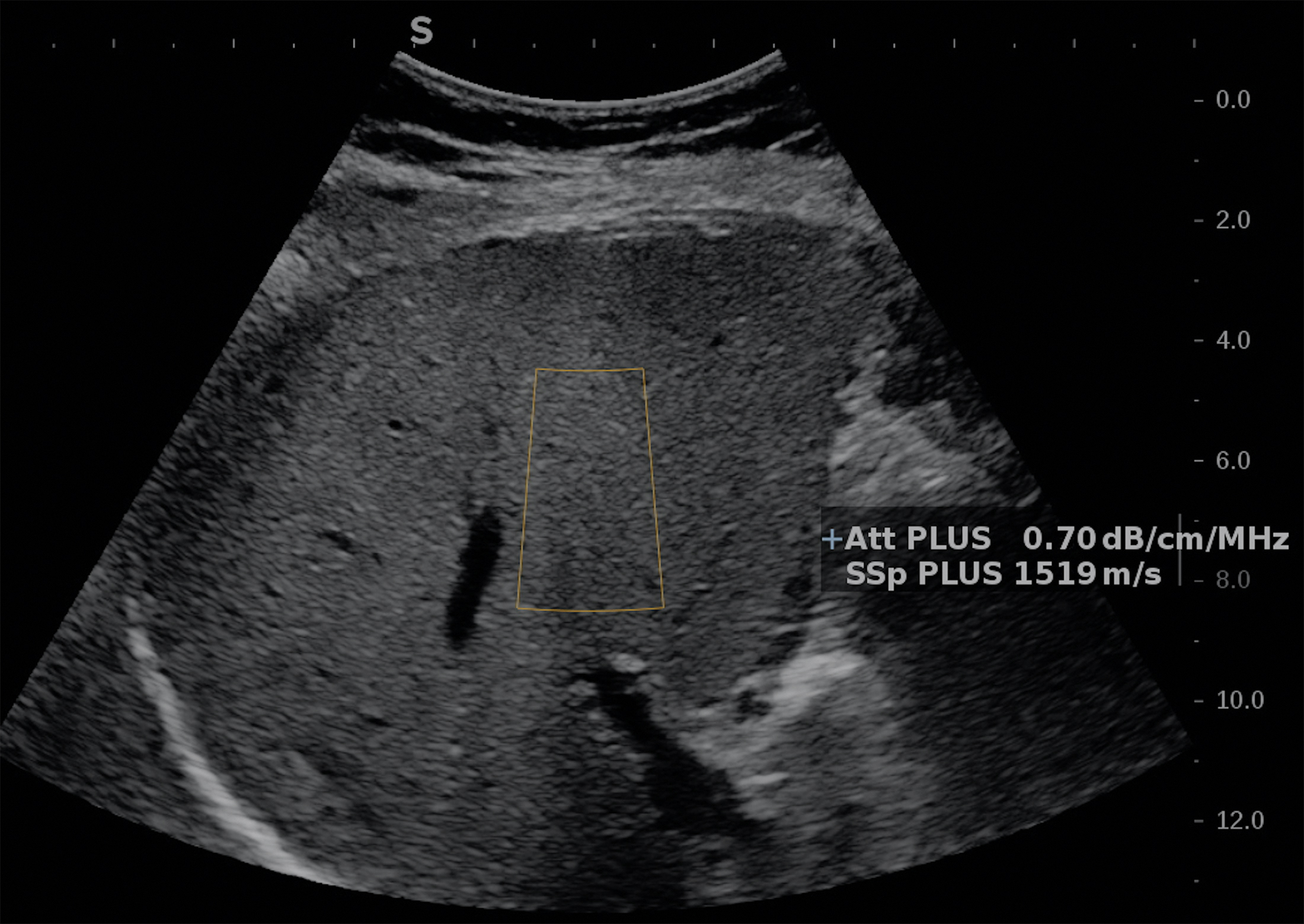 Noninvasive assessment of liver steatosis with ultrasound techniques ...