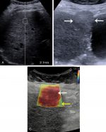 Focal liver lesions in the setting of chronic liver disease