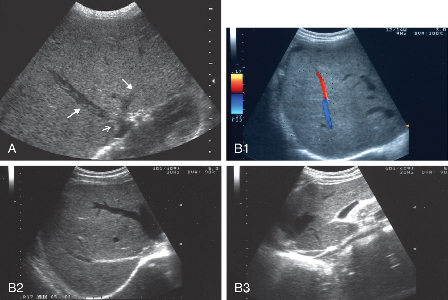 conventional-ultrasound-findings-in-chronic-liver-disease-radiology-key