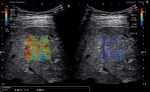Staging liver fibrosis with shear wave elastography