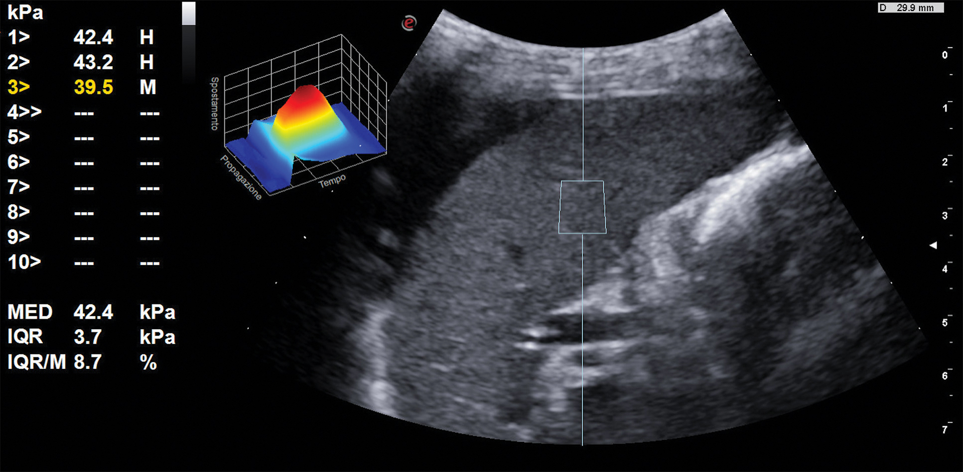 paraumbilical vein ultrasound