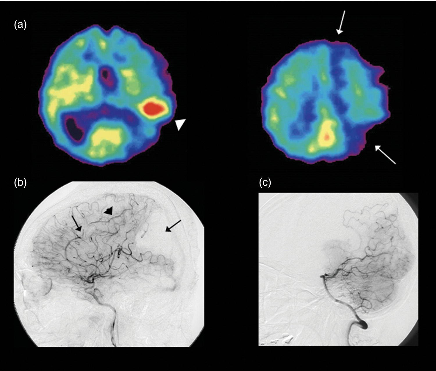 Schematic illustration of mixed state of severe hypoperfusion and postischemic hyperemia in acute cerebral infarction.