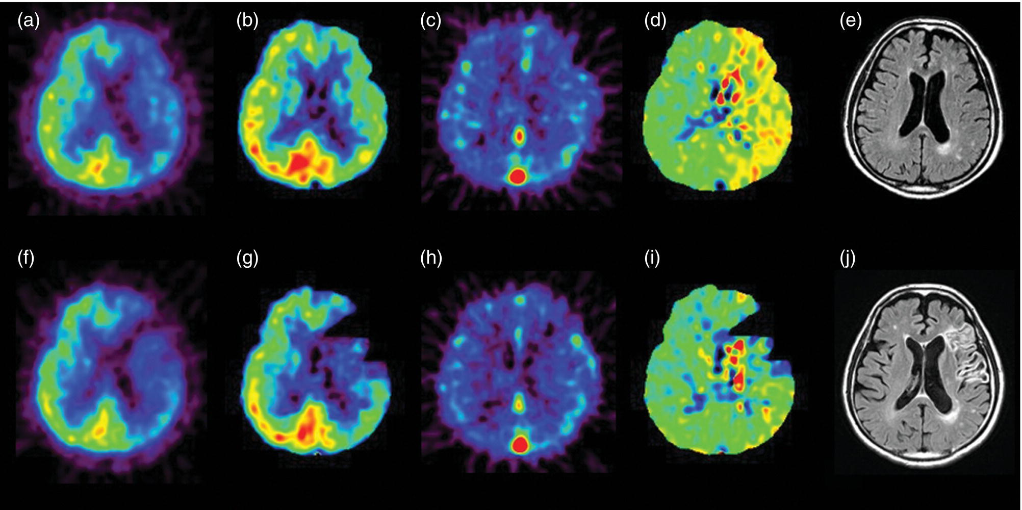 Schematic illustration of stage 2 cerebral ischemia in a cerebral infarction patient with left ICA occlusion.