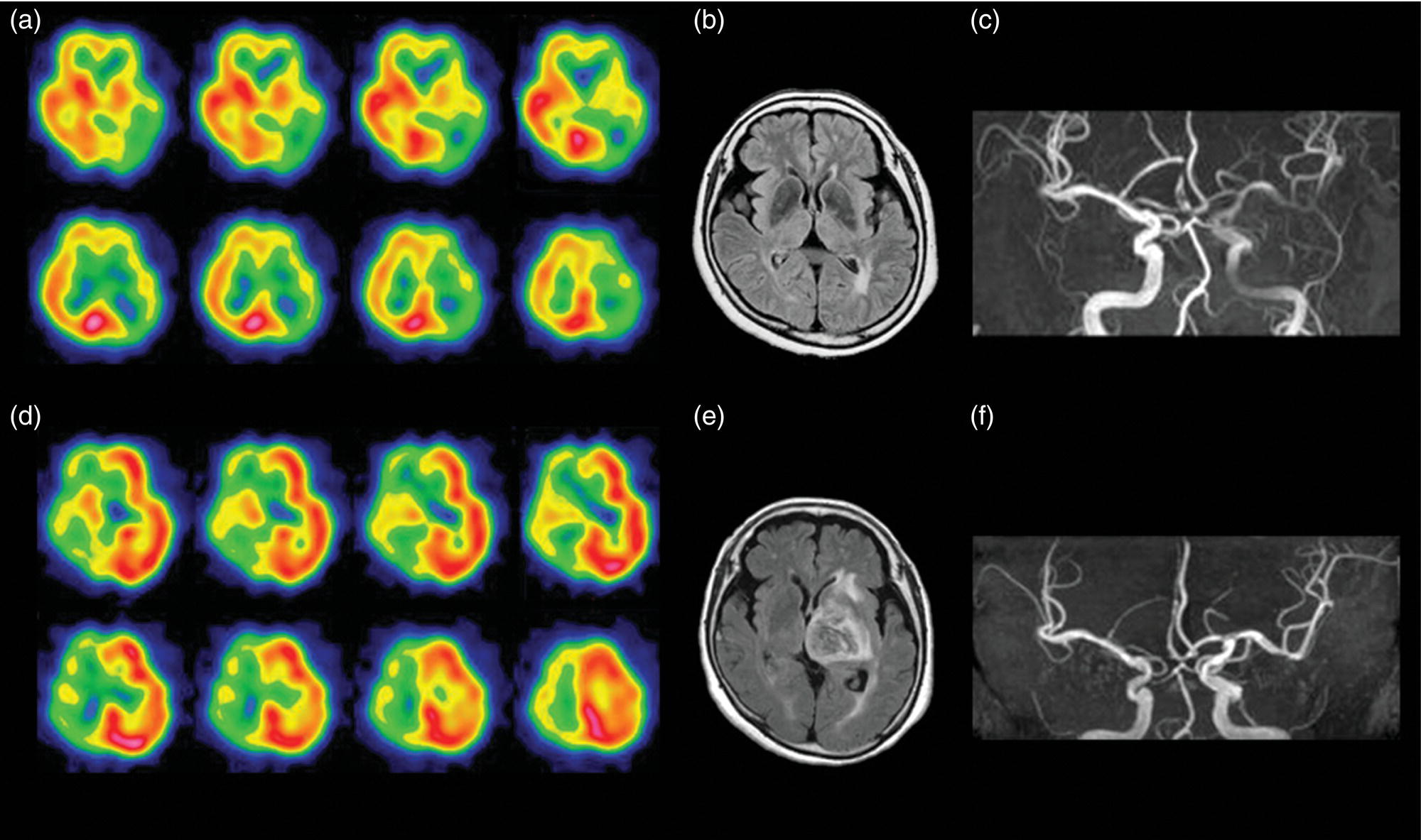 Schematic illustration of postoperative hyperperfusion in a patient with severe left ICA stenosis.