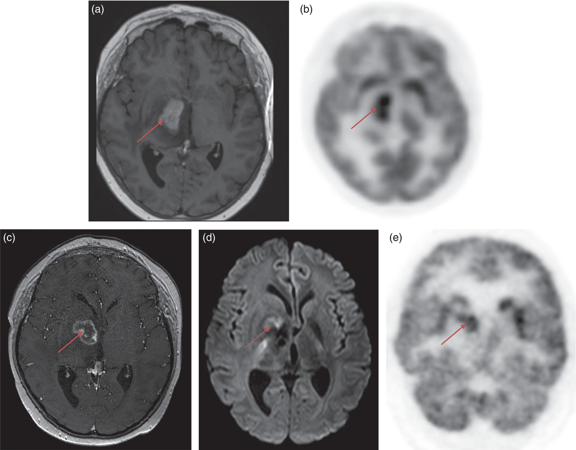 Schematic illustration of (a) 5-year-old male with right forehead swelling. (b) Axial CT image of the brain shows the frontal bone lesion with convex border (white arrows) filling the defect. (c) Sagittal CT of the brain demonstrating frontal bone lesion with mass (white arrow) filling the defect.