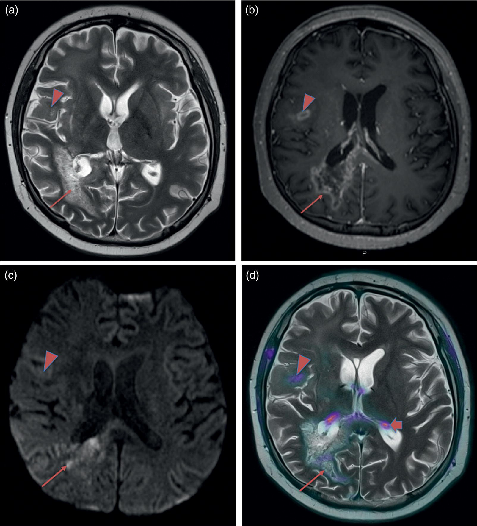 Imaging In Gliomas: Clinical Principles And Synergies With MRI ...