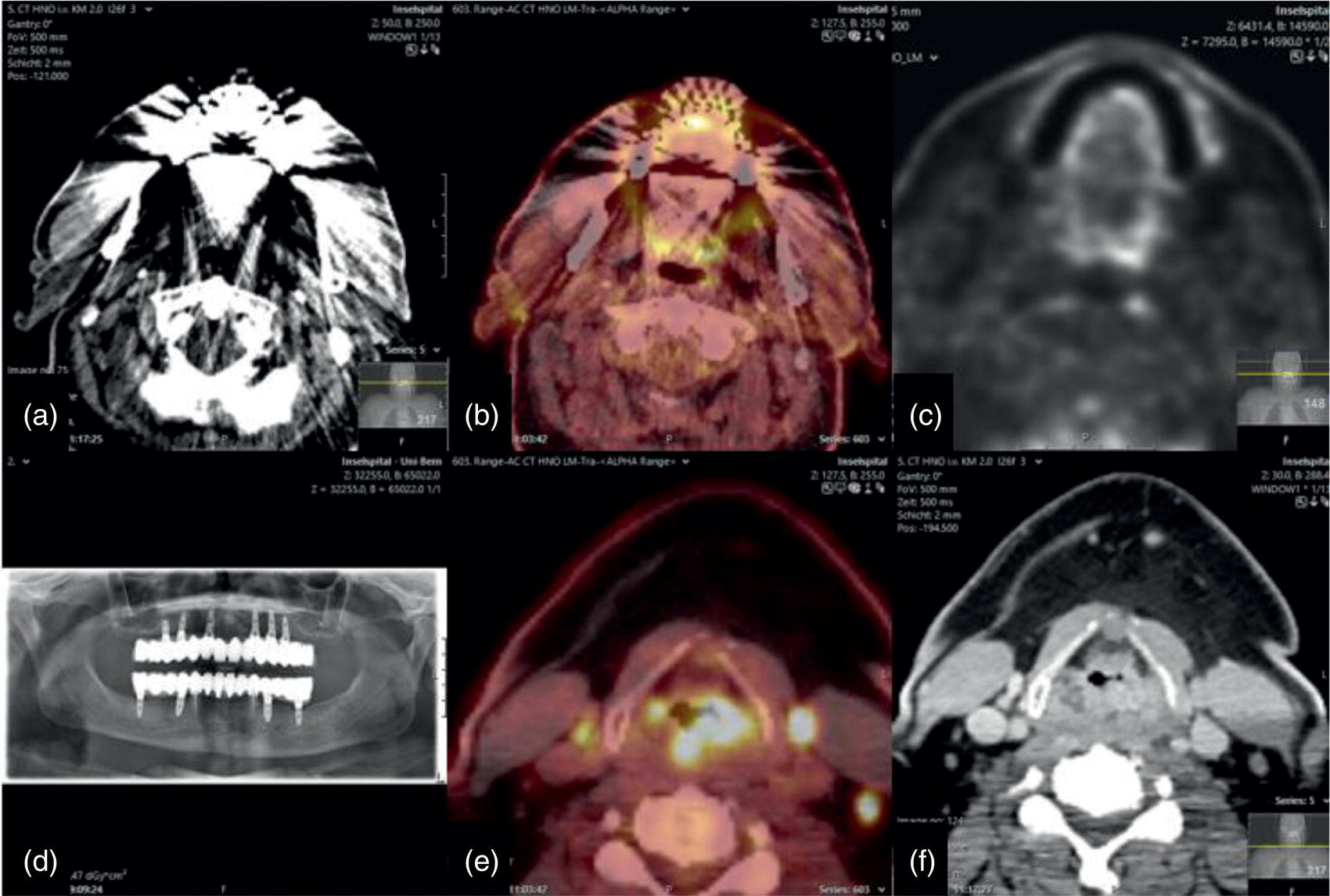 Schematic illustration of dental metal artifacts in PET-CT: tumor evaluation is not affected.