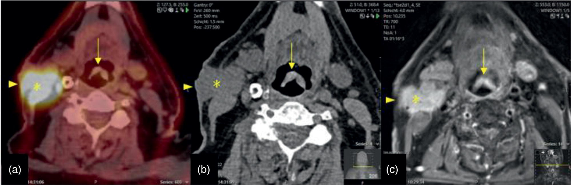 Schematic illustration of reciprocal compensation of artifacts and complementary information by PET-CT and MRI in a patient with recurrent tumor and lymph node metastases.