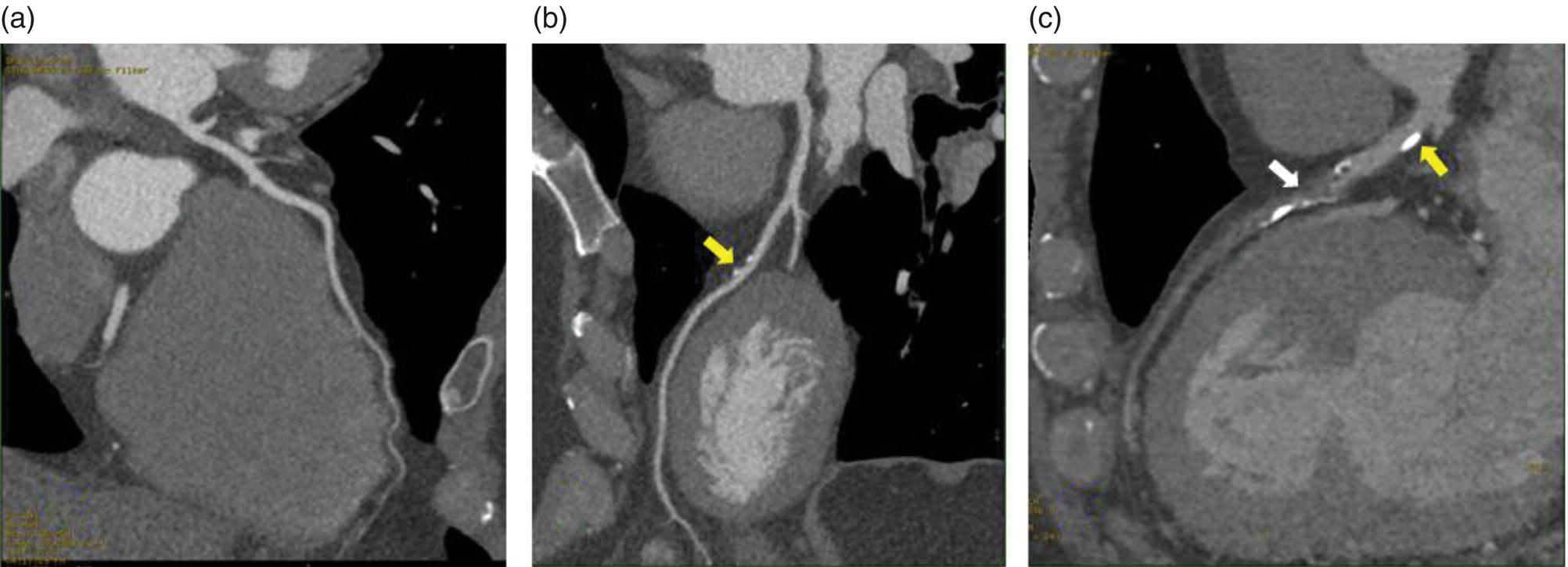 Schematic illustration of CCTA of the left anterior descending coronary artery (LAD) of three different patients: (A) normal LAD, (B) mild noncalcified plaque (yellow arrow), and (C) calcified nonobstructive plaque (yellow arrow) and mixed plaque resulting in occlusion of the mid LAD (white arrow).