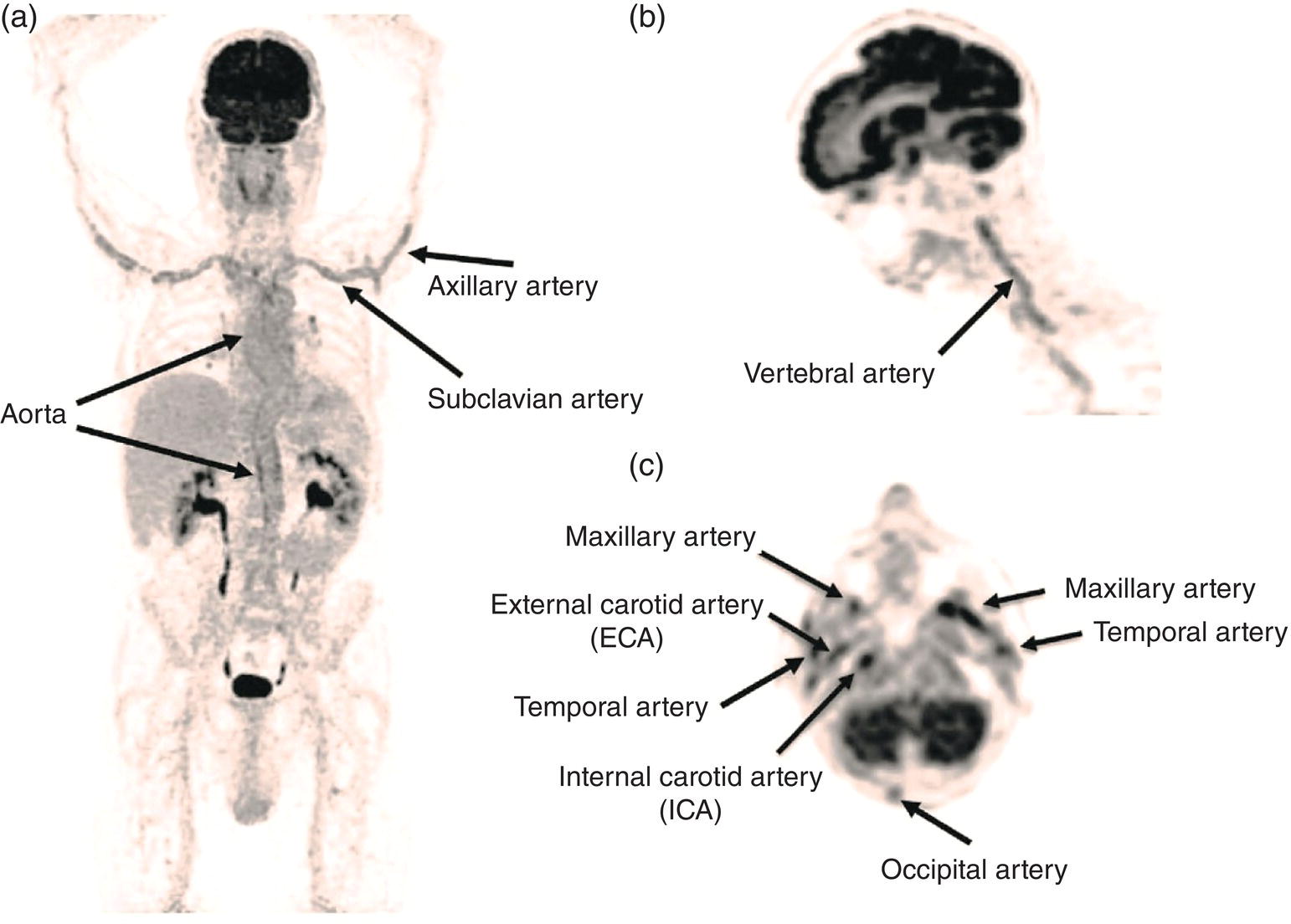 Schematic illustration of the 18F-FDG PET/CT maximum intensity projection images of GCA patients.