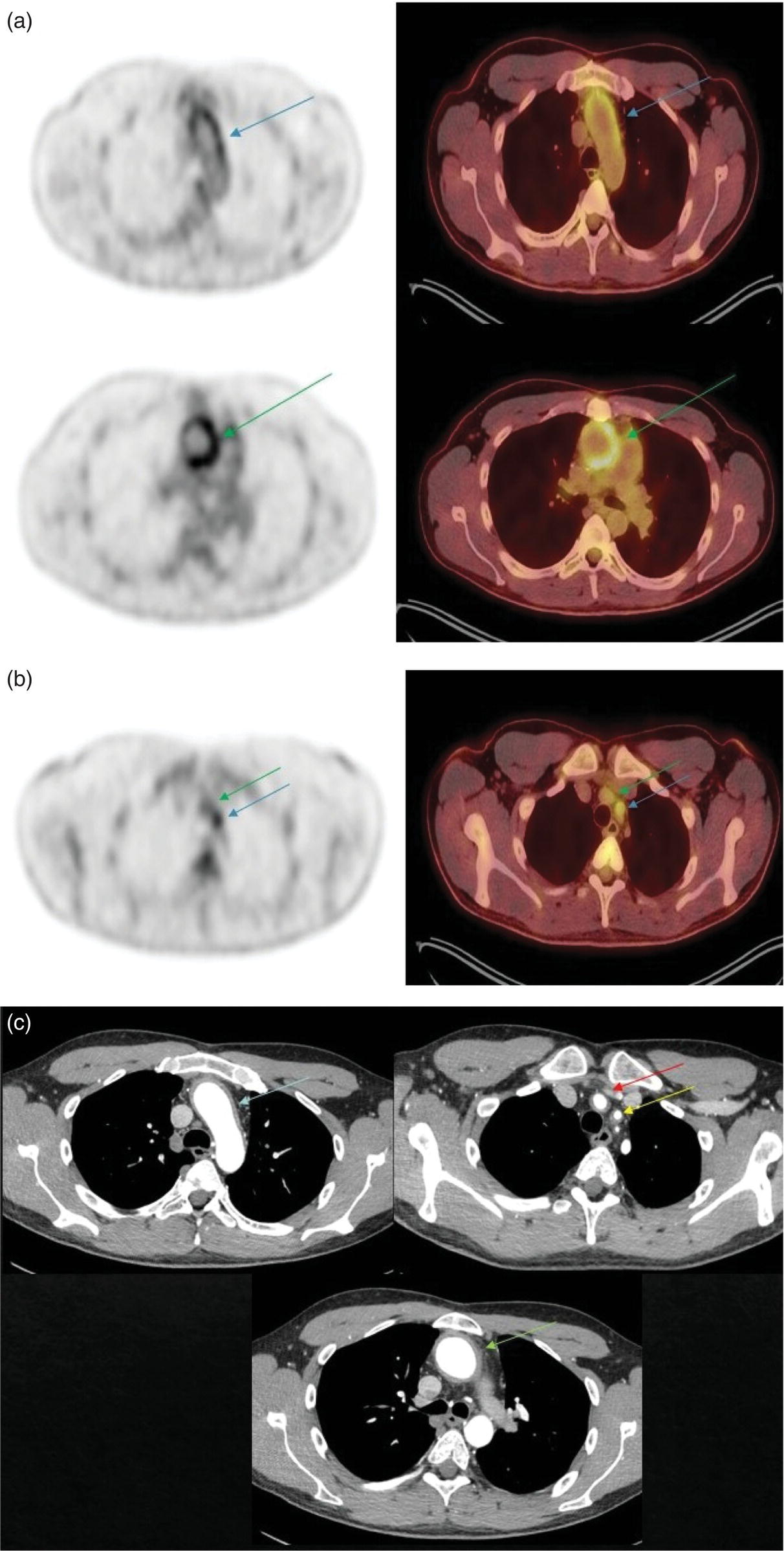 Schematic illustration of (A) axial PET and fused PET/CT images for a 34-year-old male patient with history of large vessel vasculitis of the aorta externally compressing the coronary ostia showing diffusely increased mural uptake in the anterior aortic arch (blue arrows) and ascending aorta (green arrows). (B) Axial PET and fused PET/CT images showing increased mural uptake in the proximal left common carotid artery (blue arrows) and to a lesser extent the proximal innominate artery (green arrows). (C) Axial CT angiography images of the same patient demonstrating diffuse wall thickening of the aortic arch (blue arrow), ascending aorta (green arrow), proximal left common carotid artery (yellow arrow), and proximal left innominate artery (red arrow).