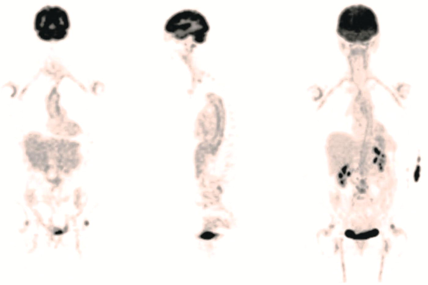 Schematic illustration of a 71-year-old woman was examined for nuchal pain, fatigue, and 10 kg weight loss in 5.5 months.