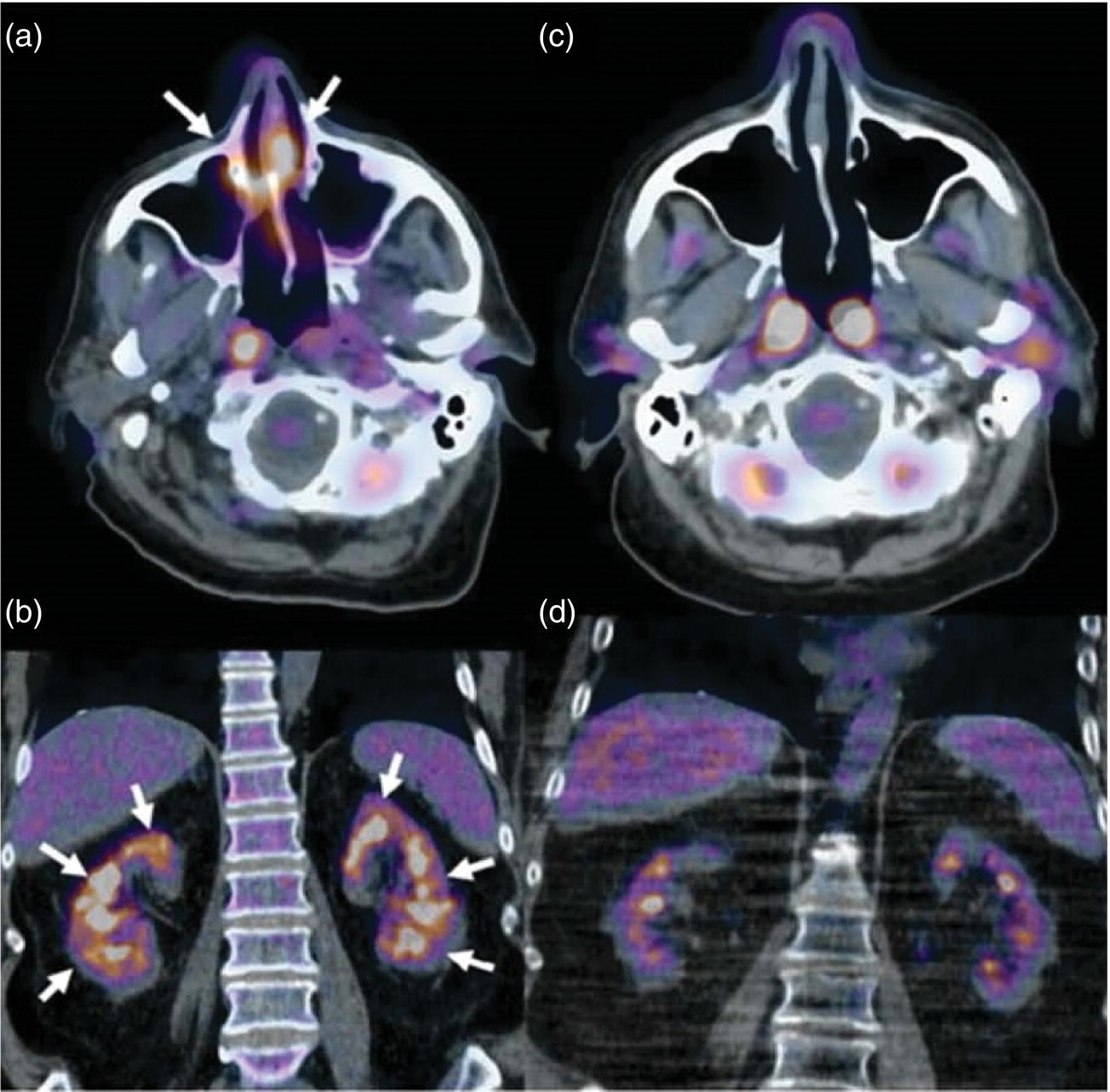 Schematic illustration of a 67-year-old woman with a granulomatosis with polyangiitis. FDG PET/CT scan shows increased FDG uptake in sinonasal and kidney locations (A and B, arrows). A follow-up FDG PET/CT scan, although the patient achieved remission, showed resolution of hypermetabolic activities in both locations (C and D).