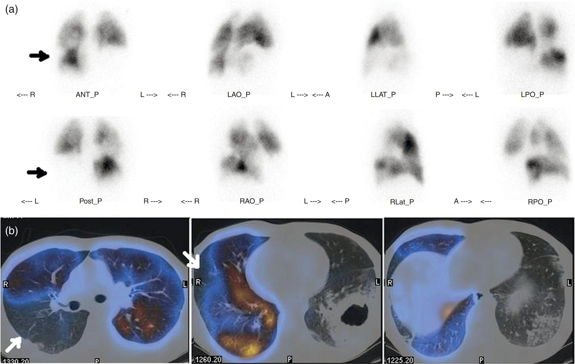 Schematic illustration of (a) planar and (b) transaxial SPECT–CT fusion images of a 56-year-old male patient admitted to the emergency department with a sudden onset of dyspnea. The planar images show large wedge-shaped perfusion defects on both lungs (black arrows).
