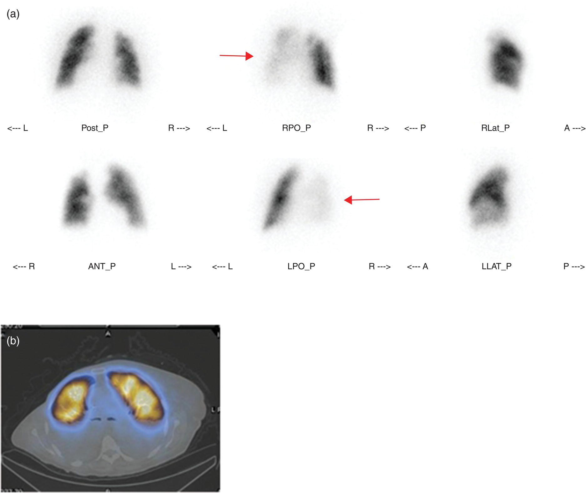 Schematic illustration of (a) planar perfusion scan and (b) SPECT–CT fusion images of both lungs and the mediastinal window showing massive pleural effusions and cardiomegaly.