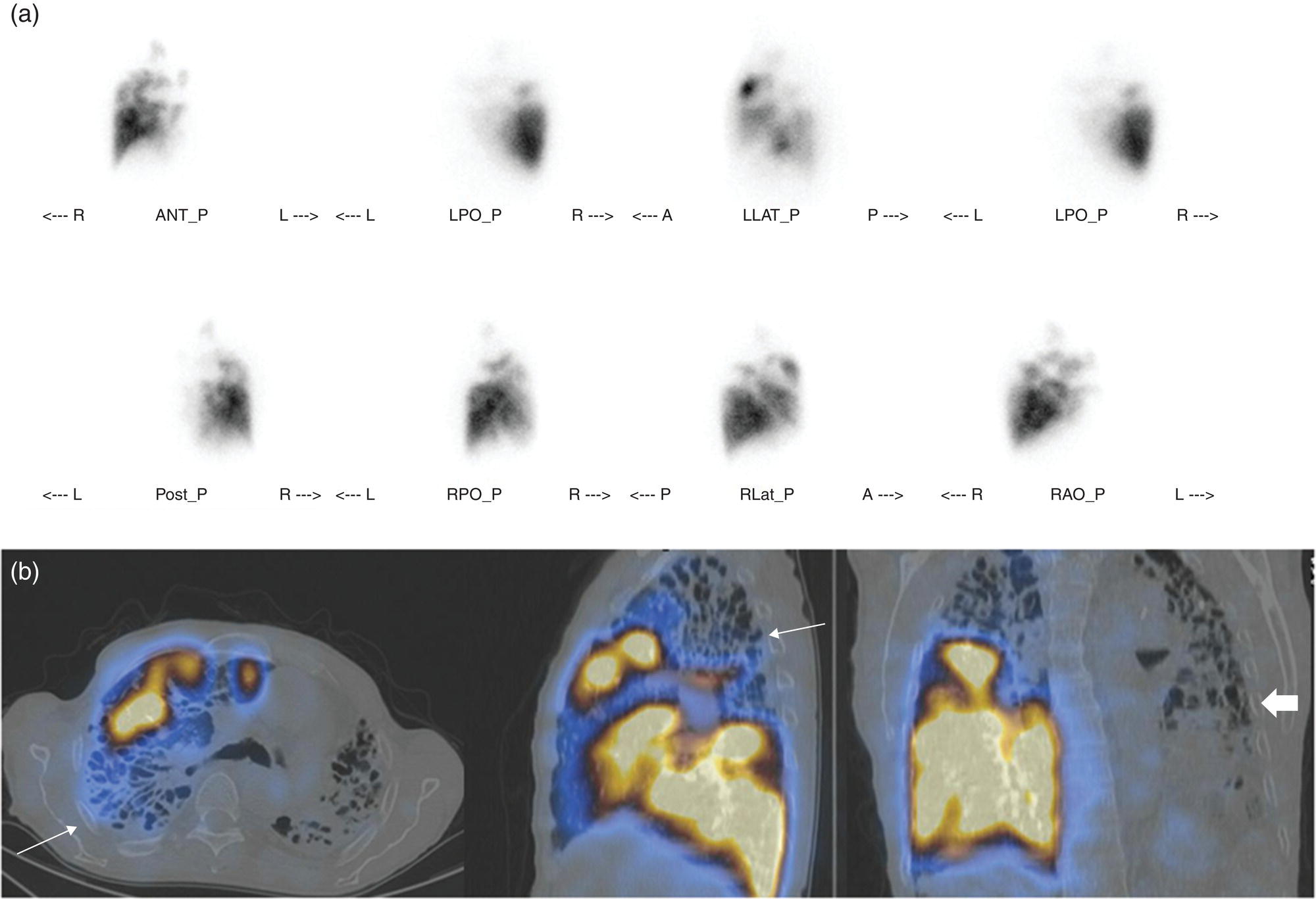 Schematic illustration of (a) planar perfusion scan and (b) cross-sectional SPECT–CT fusion images.