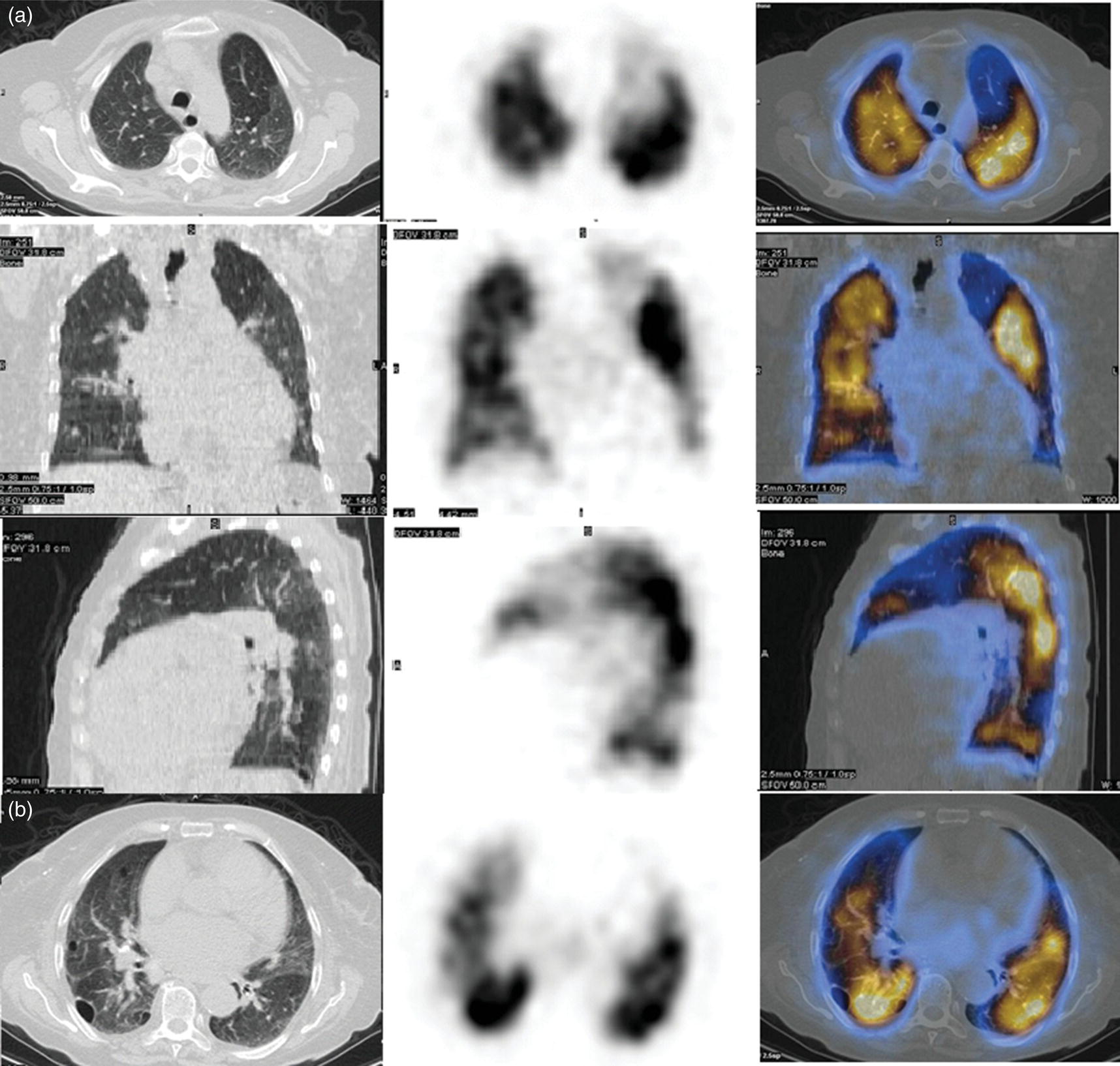 Schematic illustration of axial, sagittal, and coronal slices showing cardiomegaly and widening of mediastinal structures. A perfusion defect present at the apex of left lung has small, pleural-based perfusion defects and corresponding bullae.