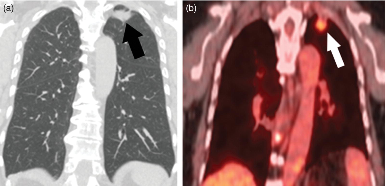 Schematic illustration of SPN. A 76-year-old female presented with cough. The noncontrast chest CT demonstrates a soft tissue density noncalcified mass within the left upper lobe (A). FDG PET/CT reveals a metabolically active lesion with SUVmax of 3.8, concerning for malignant neoplastic disease (B).