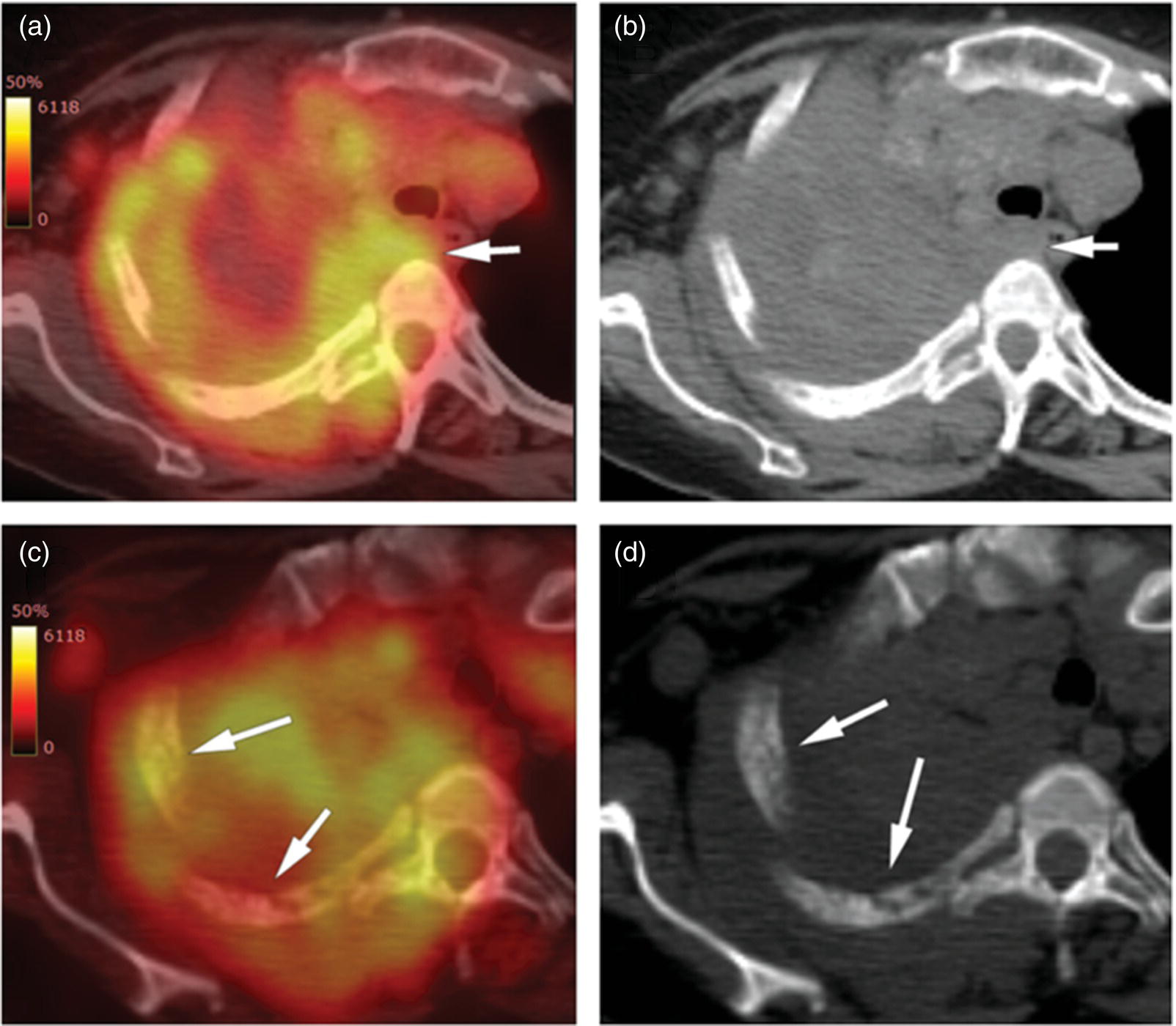 Schematic illustration of lung cancer staging. A 57-year-old man with histopathologically proven squamous cell carcinoma of the right lung. Staging FDG PET/CT shows a large heterogeneously hypermetabolic irregular soft tissue mass with SUVmax of 10.94 in the upper lobe of the right lung. Medially, the mass is infiltrating the right main bronchus and mediastinum (A and B, arrow) and laterally encasing the right first to fourth ribs with sclerosis and lysis of the ribs (C and D, arrows).