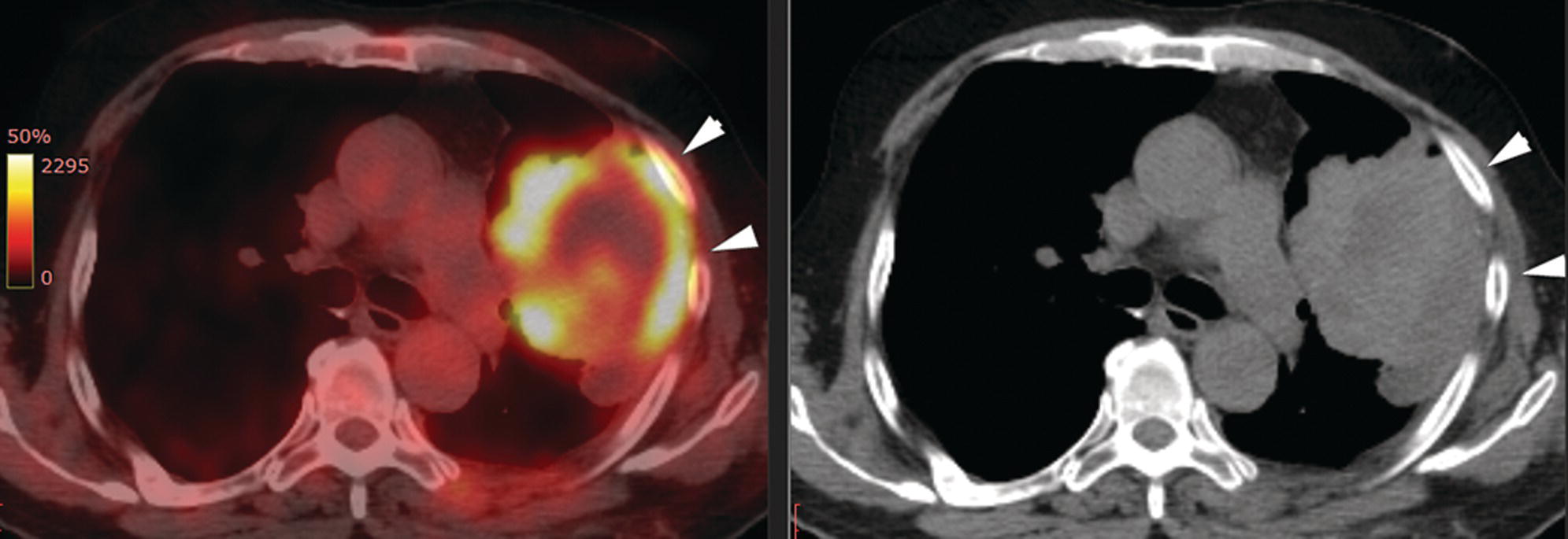 Schematic illustration of lung cancer staging. FDG PET/CT in a known case of lung adenocarcinoma shows a large hypermetabolic heterogenous soft tissue mass in the left lung abutting the left chest wall; however, chest wall or rib infiltration cannot be accurately commented on in FDG PET/CT.