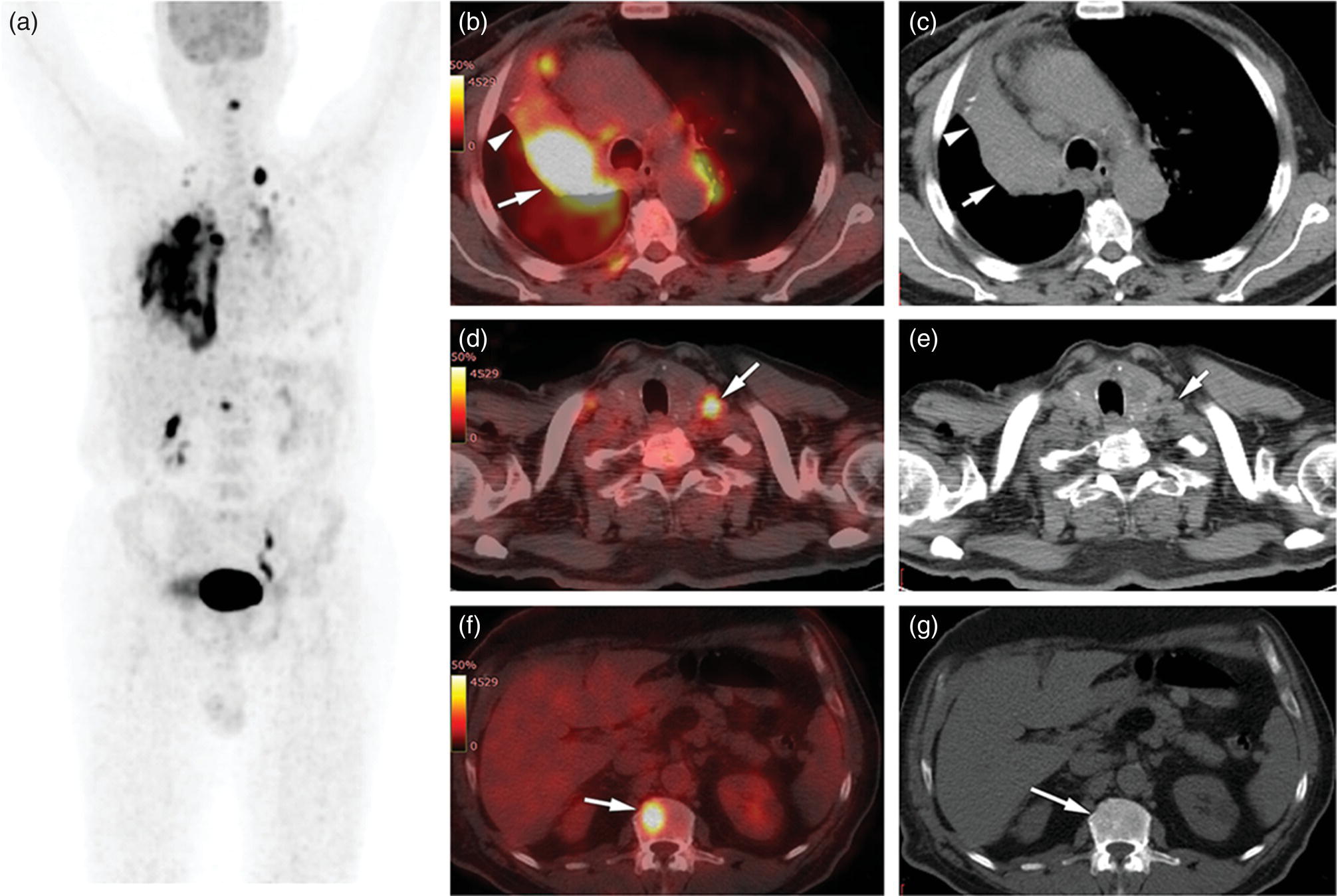 Schematic illustration of lung cancer staging.