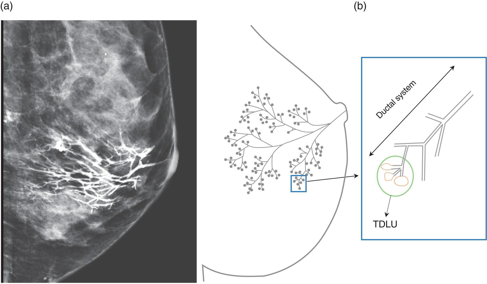 Schematic illustration of (a) lateral ductogram mammographic images obtained immediately following intraductal contrast administration via cannulation of a single periareolar lactiferous duct, illustrating the extent of a single lactiferous duct.