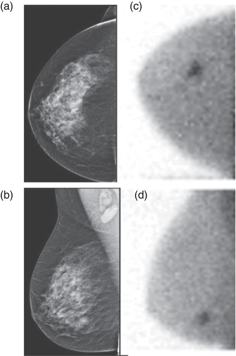 Schematic illustration of right breast craniocaudal, aka CC (a), and mediolateral oblique, aka MLO (b), standard screening mammogram views in a high-risk patient demonstrates heterogeneously dense breast tissue. The parenchymal pattern was stable from previous mammograms, without mammographic evidence for malignancy. Subsequent imaging with MBI in the CC (c) and MLO (d) projections demonstrates mass-like uptake in the lower outer quadrant that yielded invasive lobular carcinoma on tissue sampling.
