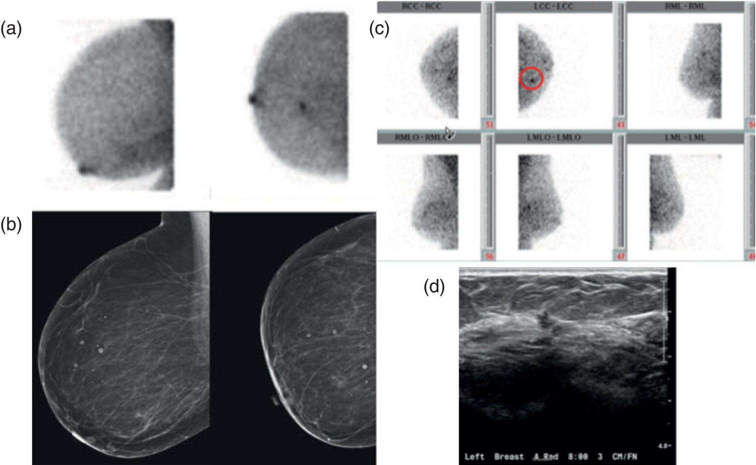 Schematic illustration of (a) MBI performed in this patient with a known malignancy in the contralateral breast demonstrates a focus of abnormal uptake in the central right breast. (b) “Second-look mammography” demonstrates a corresponding asymmetry seen when the nipple is in profile. (c) Molecular breast imaging in this patient with known right breast cancer demonstrates an abnormal focus of uptake in the medial left breast for which second-look ultrasound was recommended. (d) Second-look ultrasound demonstrates an irregularly shaped hypoechoic mass corresponding to the MBI finding.