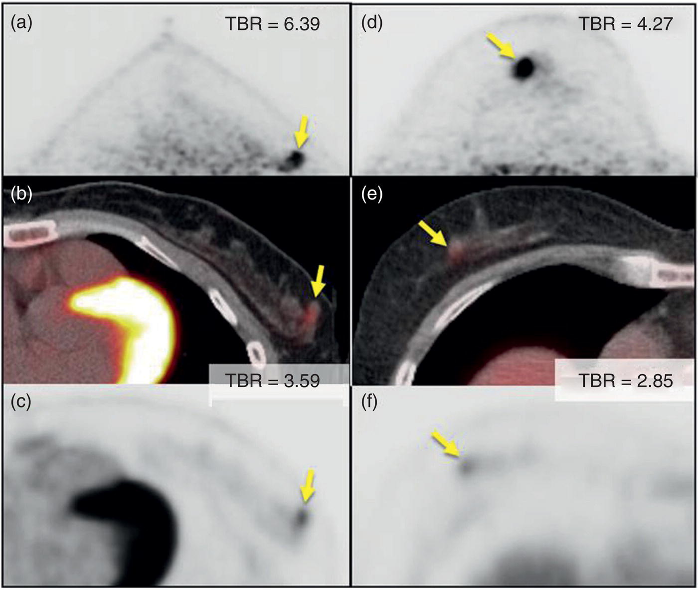 Schematic illustration of peripheral and nonperipheral breast cancer images of dbPET scanned in the prone position and whole-body PET/CT scanned in the supine position.