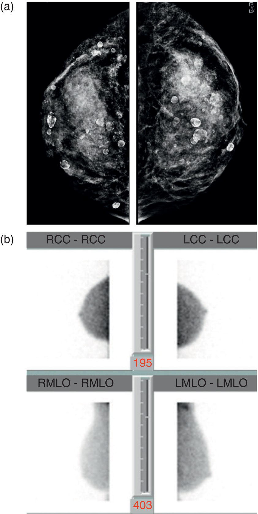 Schematic illustration of (a) screening mammogram in a patient with a history of silicone injections demonstrates innumerable injection granulomas significantly limiting evaluation for malignancy. (b) MBI in this patient demonstrates no abnormal uptake.