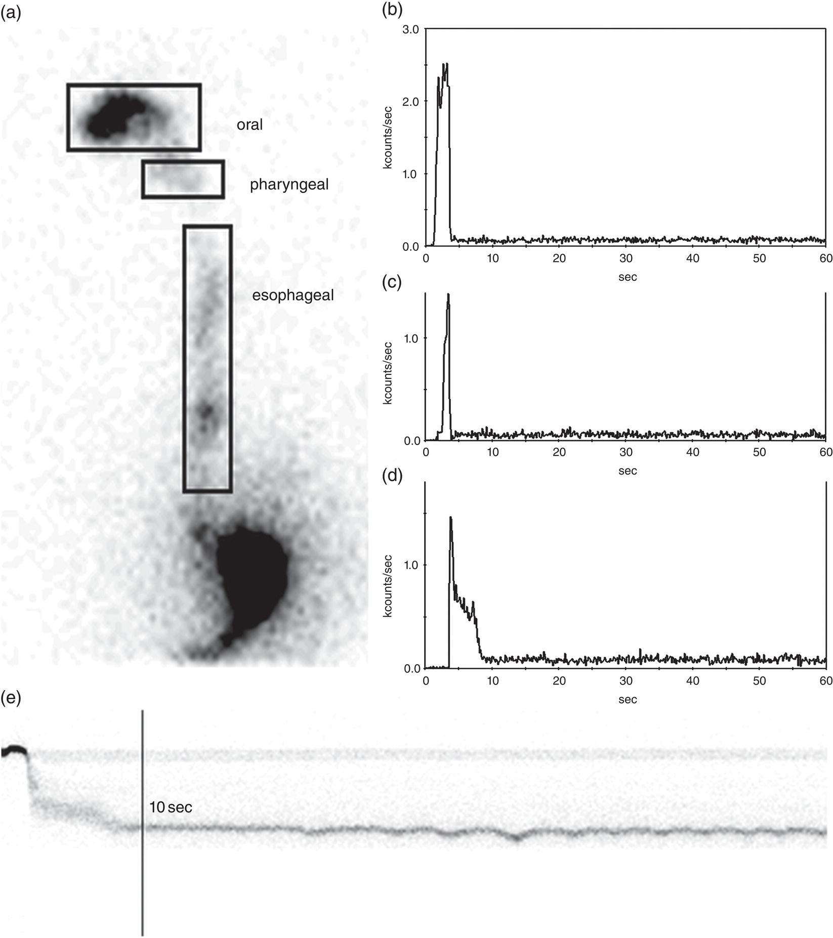 Schematic illustration of oropharyngo-esophageal transit scintigraphy (OPES) in a healthy volunteer.