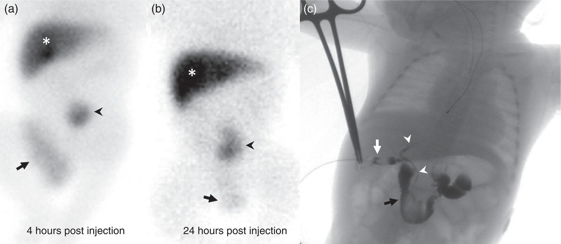 Schematic illustration of false-positive HIDA scan: neonatal hepatitis.