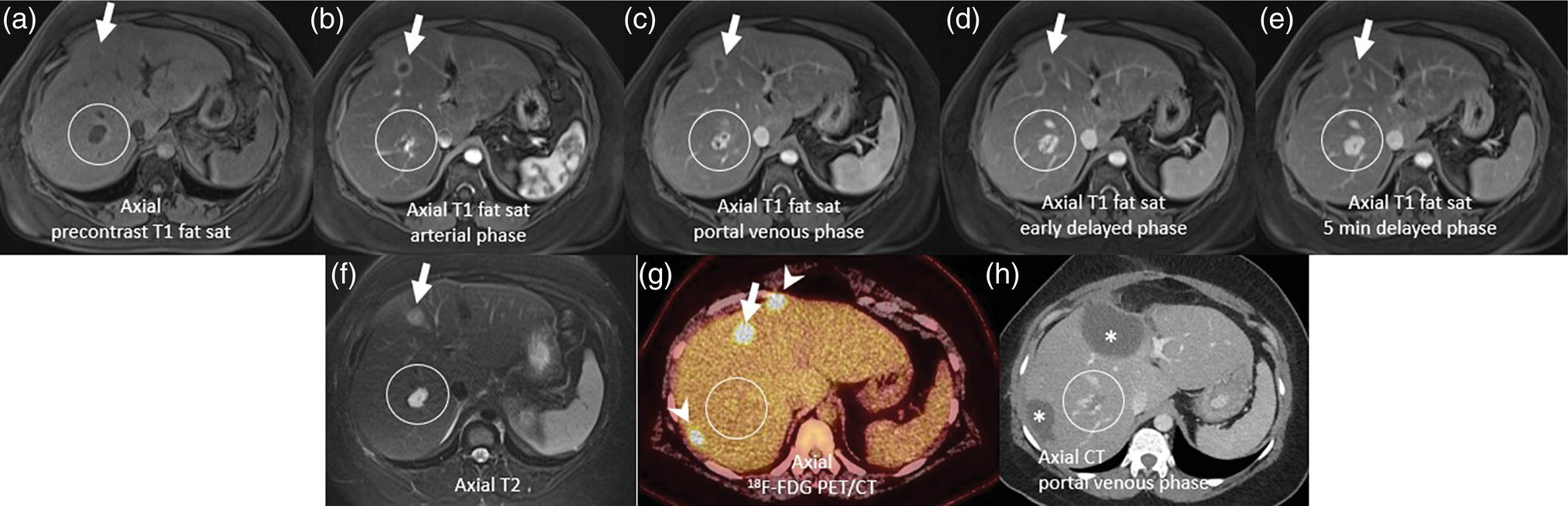 Schematic illustration of MRI and 18F-FDG PET/CT of hepatic metastases and hemangioma prior to metastasectomy.