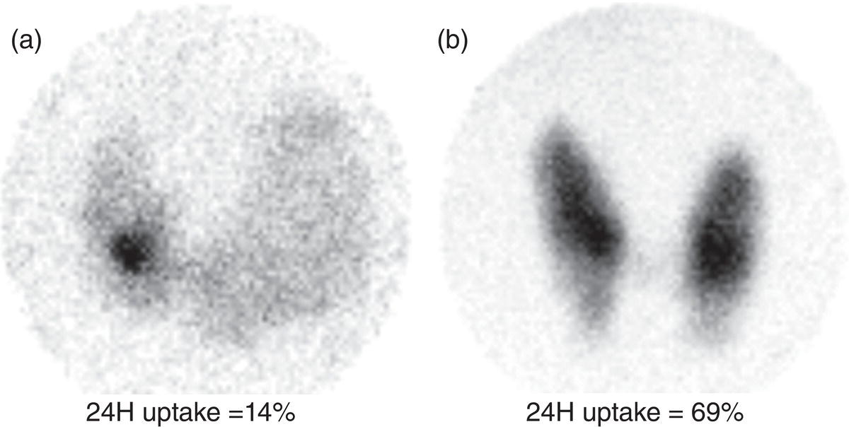 Schematic illustration of radioiodine thyroid planar scintigraphy anterior–posterior views and uptake in two patients with clinical hyperthyroidism, severely suppressed TSH, and goiter.