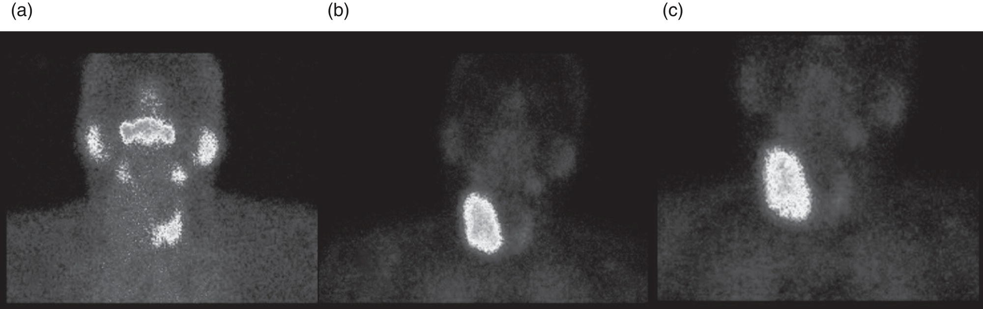Schematic illustration of 99mTc-MIBI scintigraphy for differentiation of malignant thyroid lesions in a 40-year-old female with a cold nodule on 99mTc thyroid scan (a). Early (b) and delayed (c) phase 99mTc-MIBI scintigraphy demonstrate obvious retention of 99mTc-MIBI. FNA biopsy of the patient indicated a benign lesion, but the excision biopsy showed papillary thyroid carcinoma.