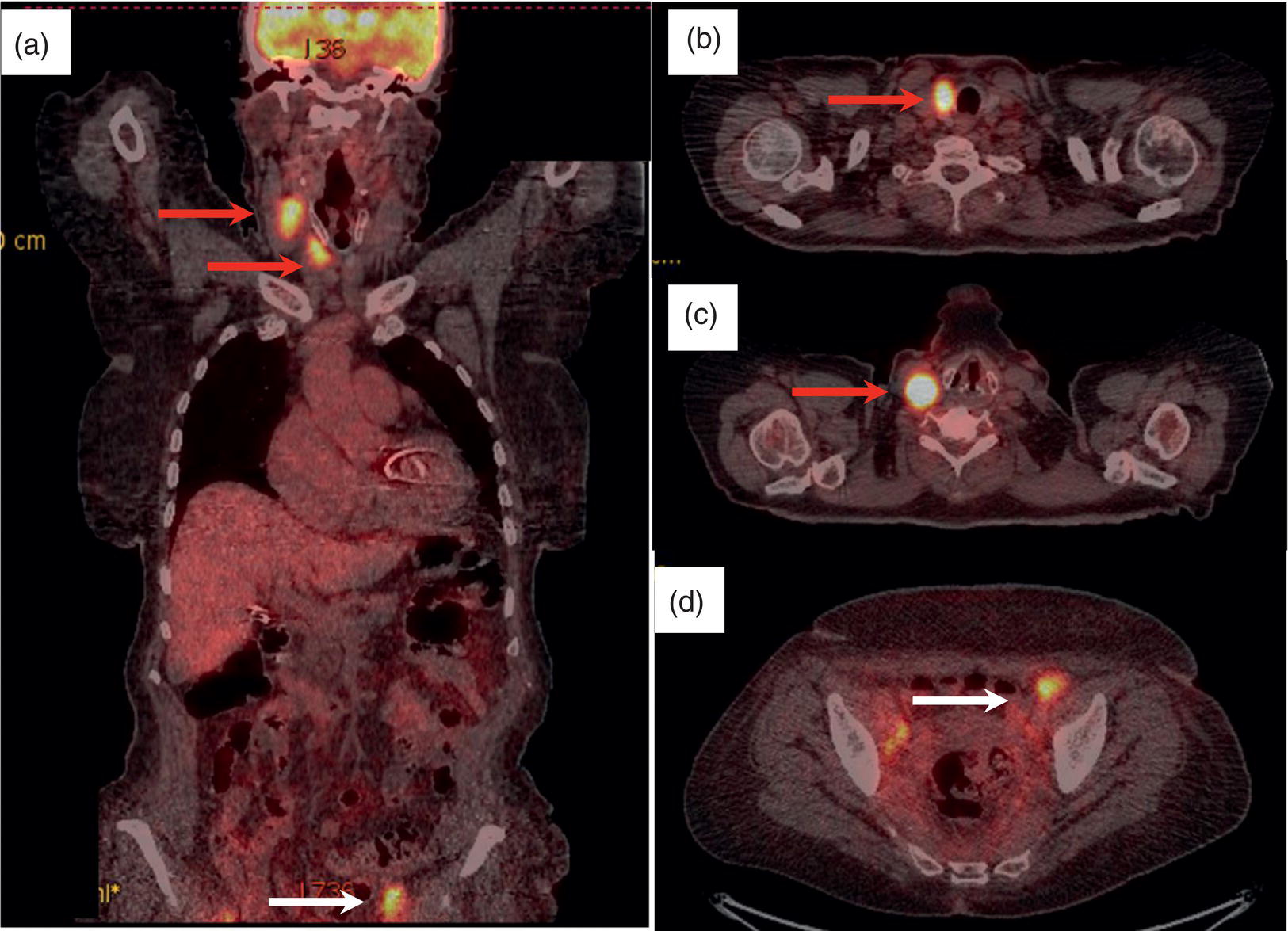 Schematic illustration of 18F-FDG PET/CT coronal view (a) and pelvic axial view (d) of a patient with cervix carcinoma during follow-up showing multiple metastatic lymph nodes in the pelvic region (white arrows) and pathologic increased uptake (SUVmax 18.1) in the right thyroid lobe (red arrow, axial view b) with right latero-cervical lymphadenopathy (red arrow, axial cervical view c). The histology after thyroidectomy revealed synchronous papillary thyroid carcinoma with lymph node metastases.