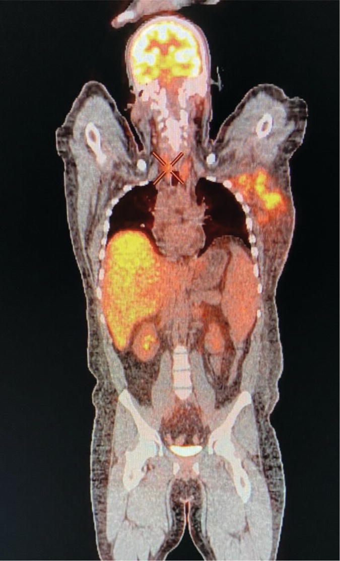 Schematic illustration of coronal view 18F-FDG PET/CT in a 25-year-old male patient with left axillary metastatic malignant melanoma, showing increased diffuse uptake in liver (hepatitis) and thyroid (thyroiditis) suggestive of adverse effects to immune checkpoint inhibitor therapy.