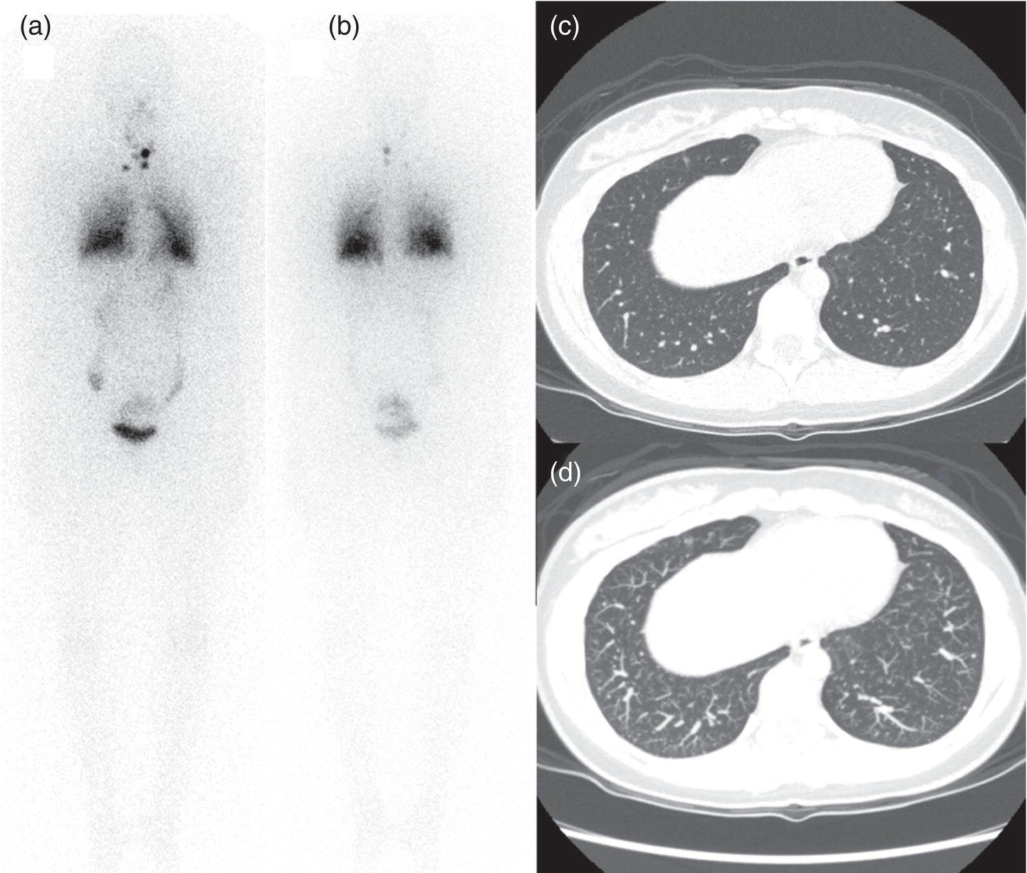 Schematic illustration of an 18-year-old female with papillary thyroid cancer. 123I whole-body scan was performed following thyroidectomy. Anterior and posterior Whole body scintigraphy (a, b) show residual uptake in the thyroidectomy bed, bilateral nodal uptake in the neck. and diffuse uptake in the lungs consistent with metastatic involvement. The chest CT (c, d) demonstrates very small scattered pulmonary nodules, better seen in the maximum intensity projection (d).