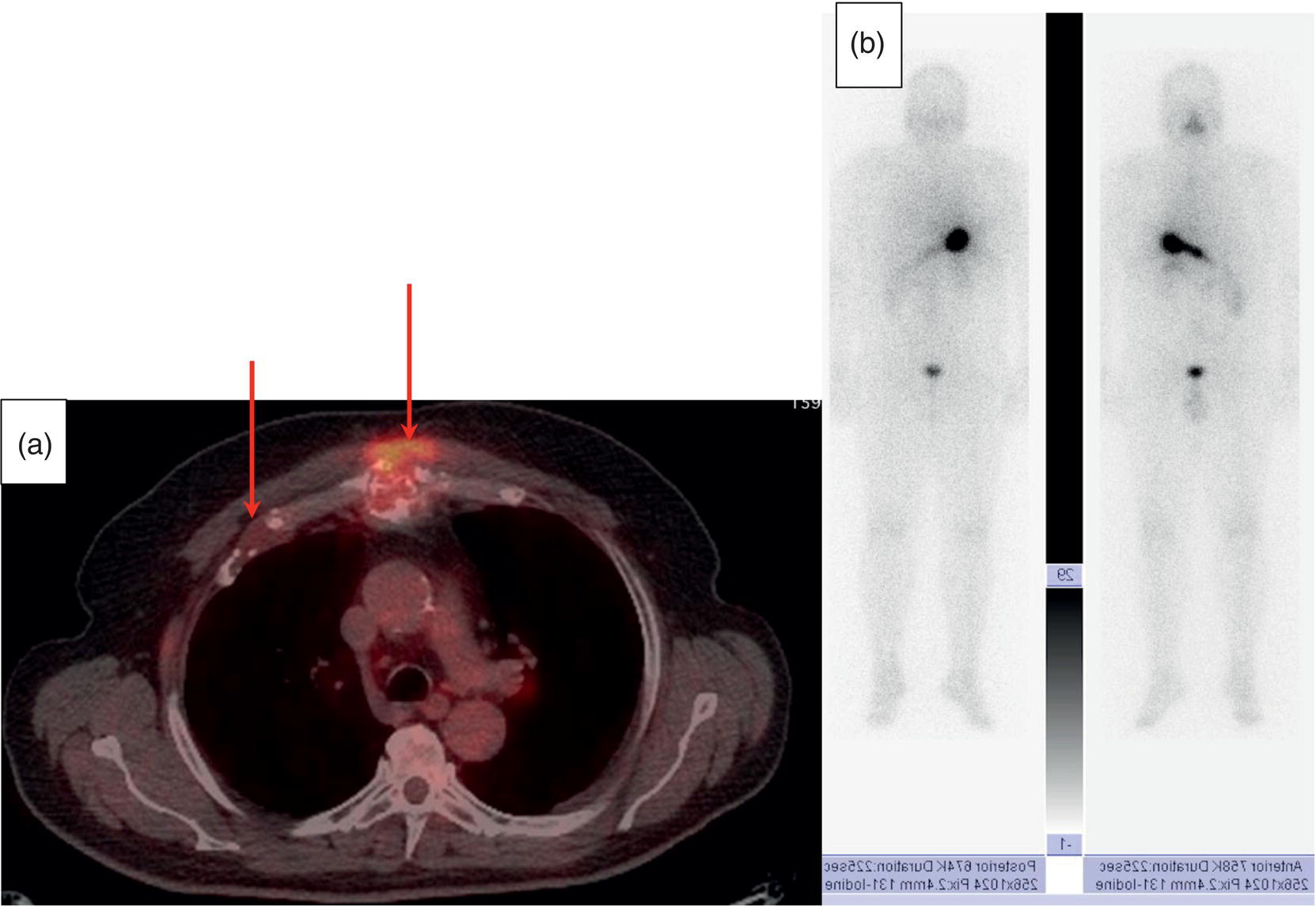 Schematic illustration of axial image of the chest of 18F-FDG PET/CT in a 62-year-old man with follicular thyroid carcinoma radically treated by surgery and radioiodine therapy. The hybrid image PET/CT (a) shows sternal and rib metastatic lesions, despite the negative 131I whole-body scan (b).