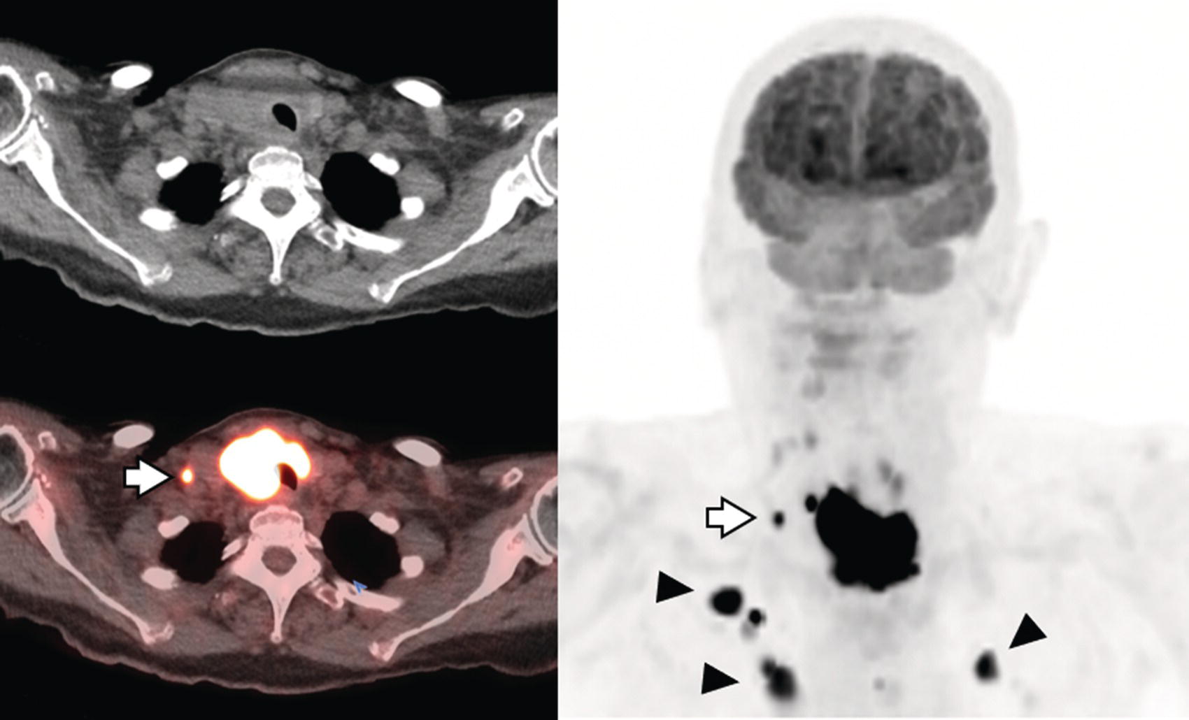 Schematic illustration of 18F-FDG PET/CT in a 90-year-old female with newly diagnosed anaplastic thyroid carcinoma.