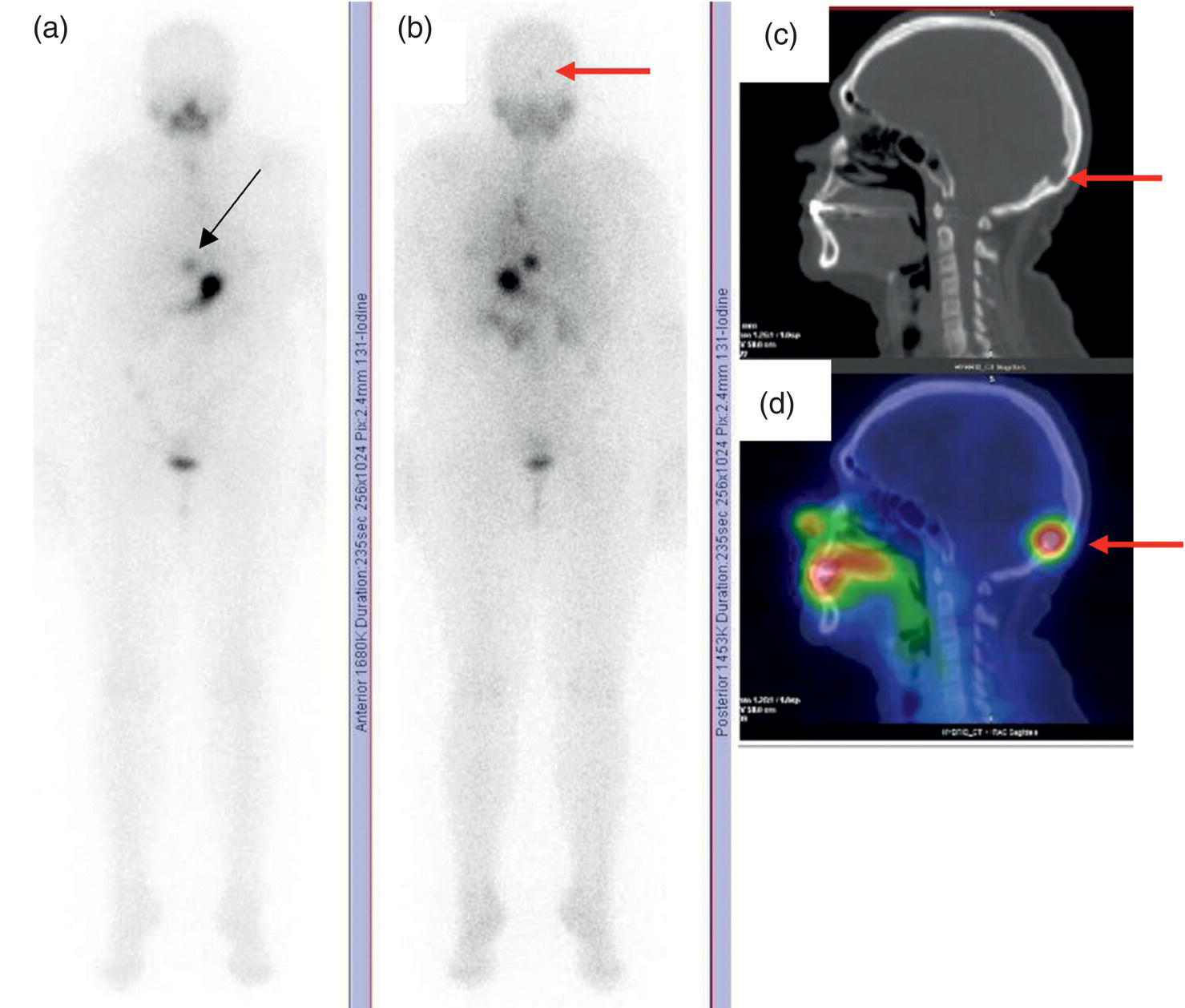 Schematic illustration of post-therapeutic 131I whole-body scans (a, antero-posterior view; b, postero-anterior view) in a case of aggressive papillary thyroid carcinoma showing pathologic radioiodine uptake in the lungs and dorsal spine (black arrow), and faint uptake in the skull.