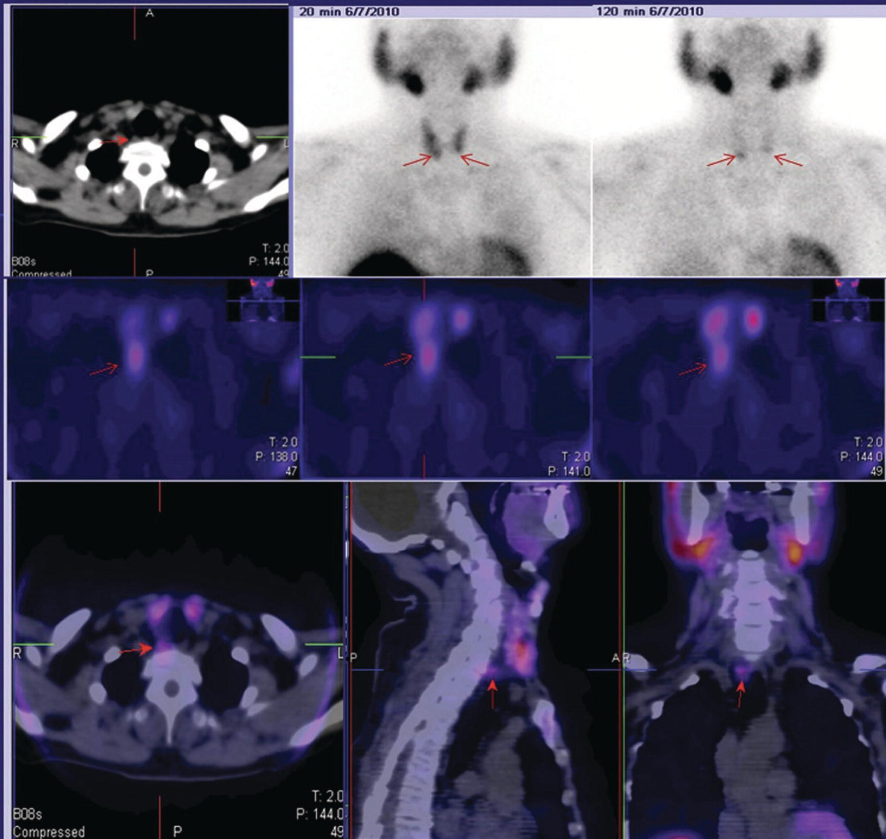 Schematic illustration of SPECT-CT of the parathyroid.