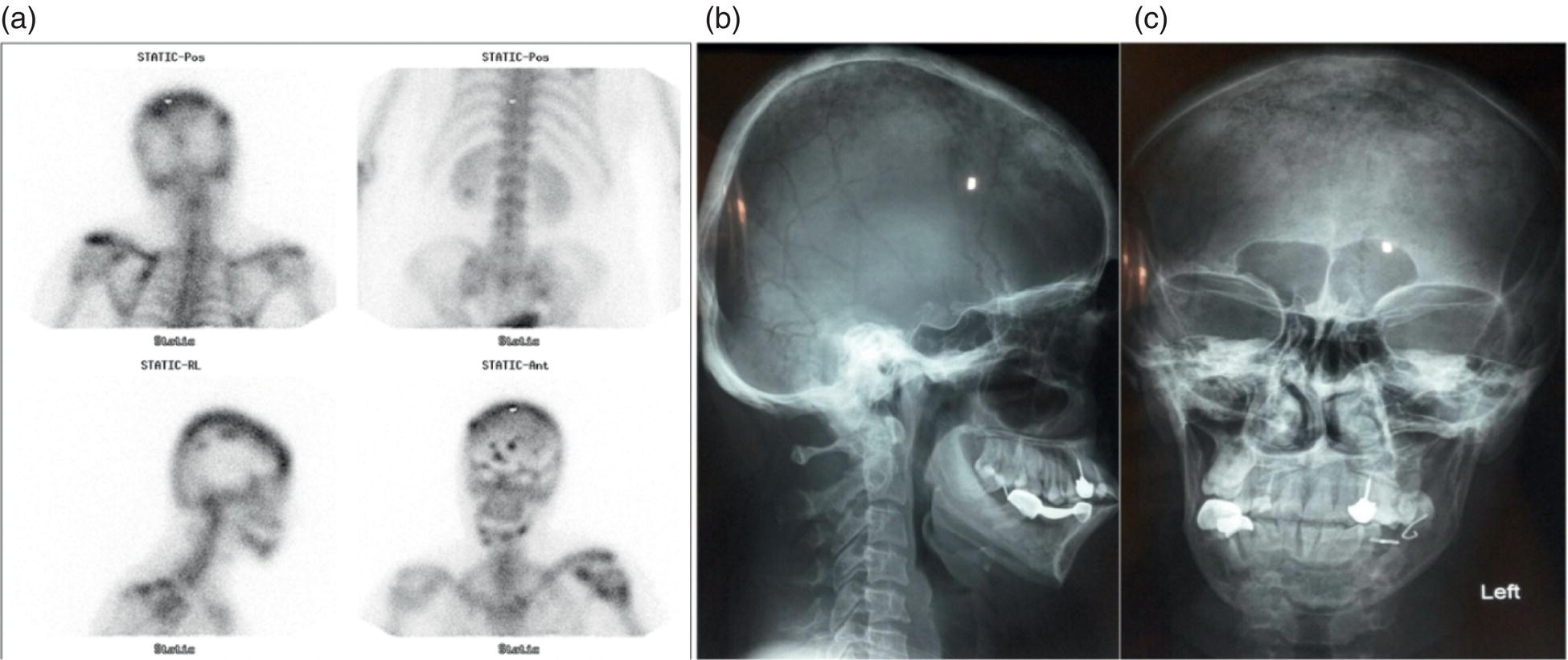 Schematic illustration of parathyroid adenoma with brown tumor.