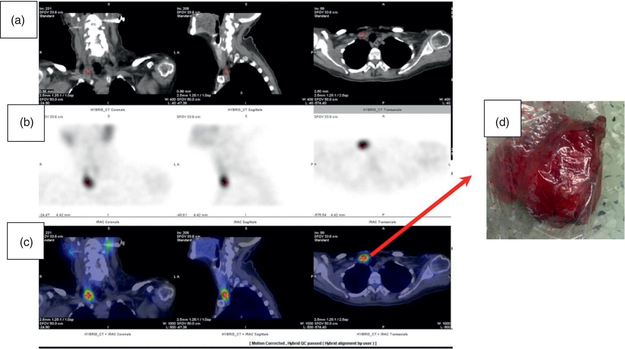Schematic illustration of 99mTc-MIBI SPECT/CT, coronal, sagittal, and axial views (a, CT; b, nuclear SPECT; c, fused SPECT/CT), showing a macroadenoma of the right inferior parathyroid (red arrow) confirmed by the surgical specimen (d).