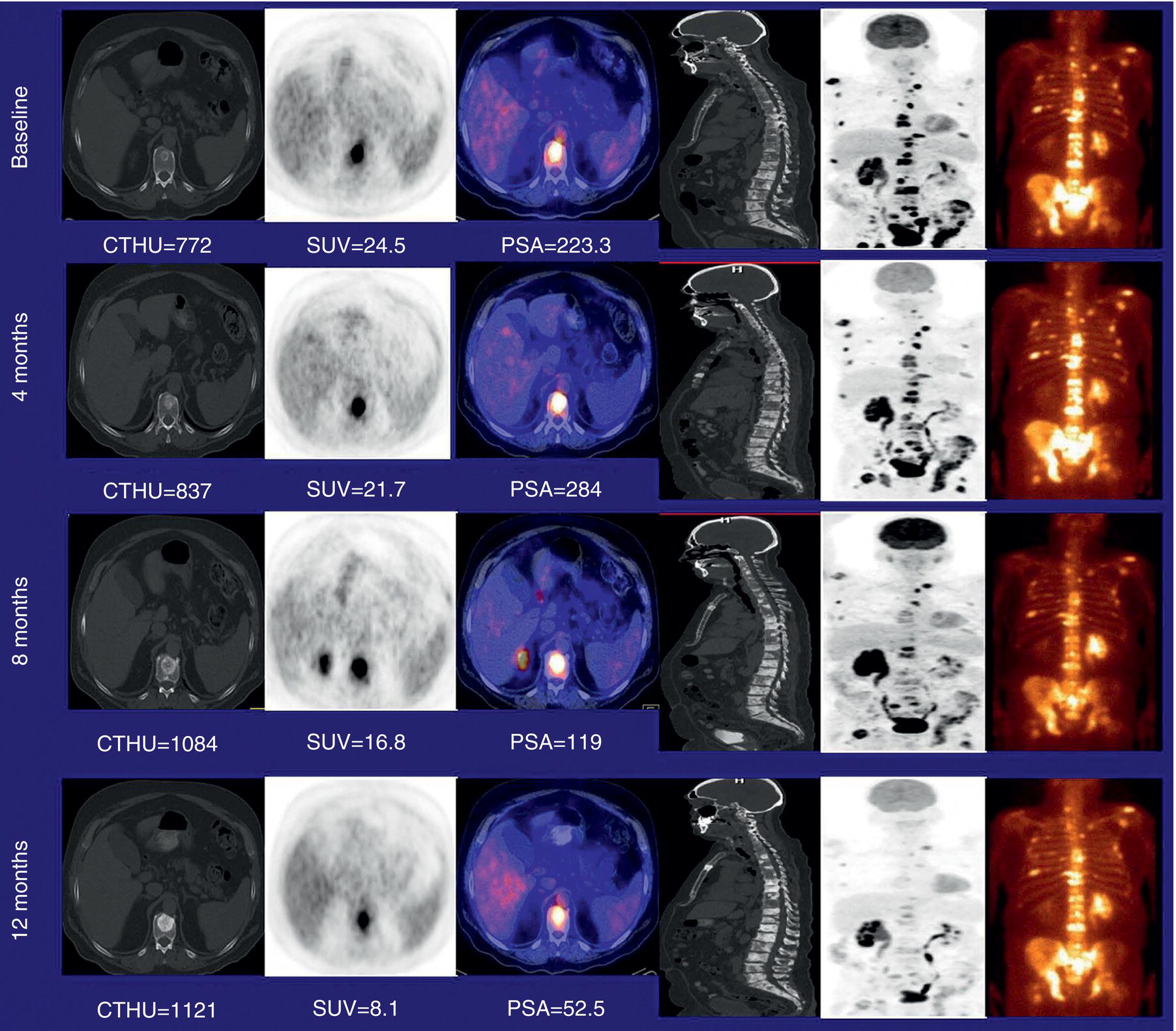 Schematic illustration of treatment response evaluation with FDG PET/CT in metastatic castration-resistant prostate cancer. The patient was scanned at baseline and at 4, 8, and 12 months (rows) after the start of docetaxel chemotherapy.