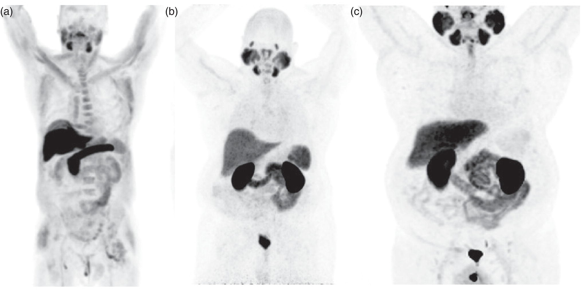 Schematic illustration of (A) normal distribution of 18F-fluciclovine PET. (B) Normal distribution of 68Ga-PSMA-11 PET is similar to (C) 18F-DCFPyL PET. Note the urine activity and significant GI tract activity in both scans.